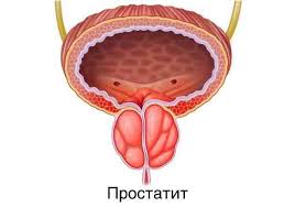 простатит